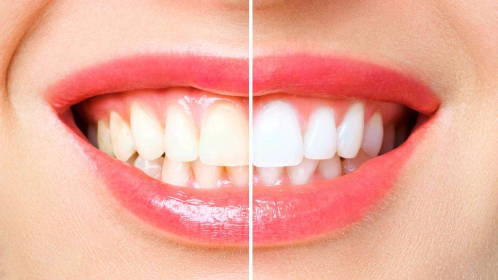 Teeth Whitening | Douglas A. Bleyenburg DDS | Holland, Michigan